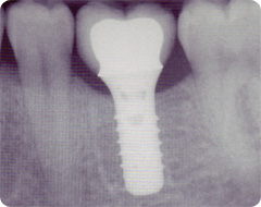 Implantat